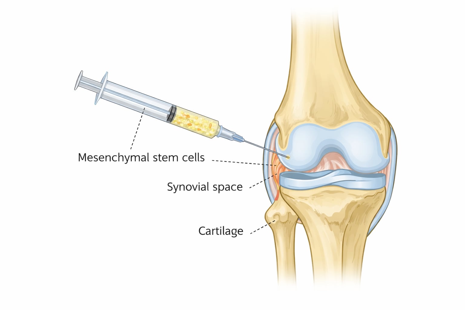 Ilustrasi medis injeksi sel punca mesenkimal ke dalam rongga sendi lutut untuk terapi osteoarthritis